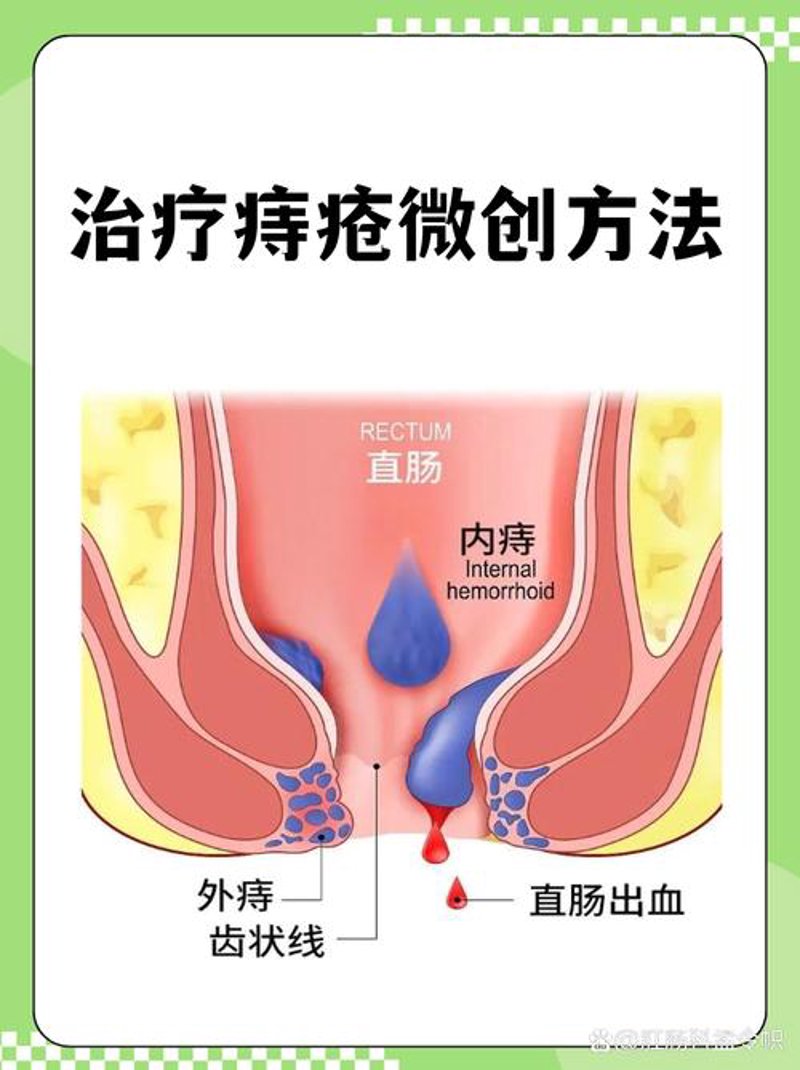 痔疮治疗：轻松告别肛门疼痛的实用技巧