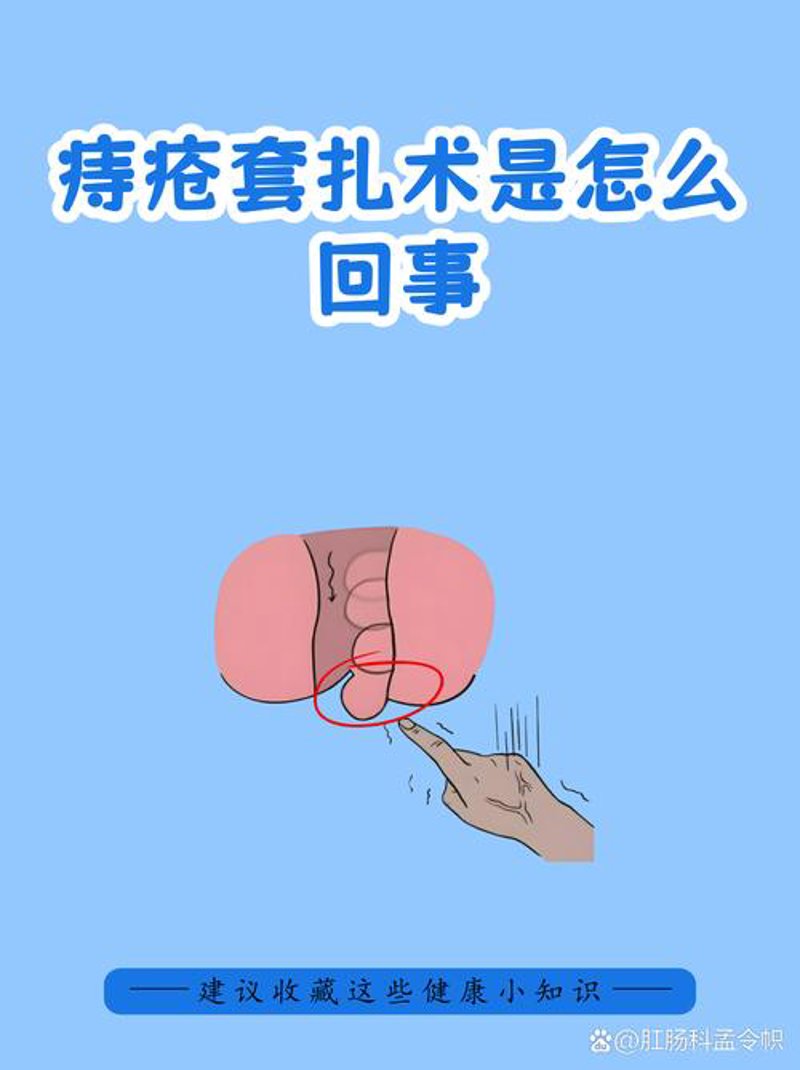 痔疮治疗